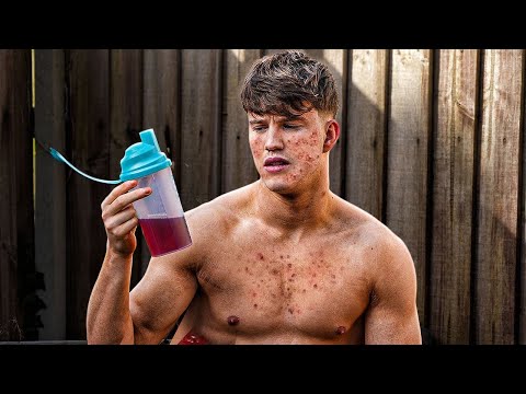 Do Protein Shakes Cause Acne?